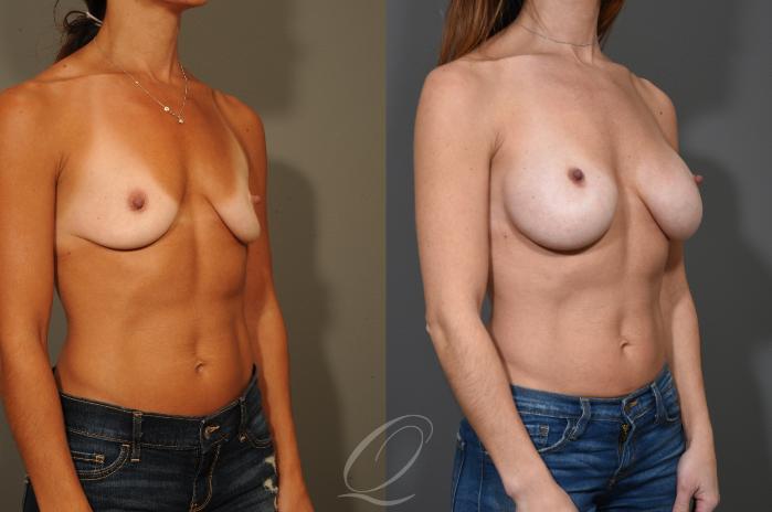 Breast Augmentation Case 325 Before & After View #2 | Serving Rochester, Syracuse & Buffalo, NY | Quatela Center for Plastic Surgery