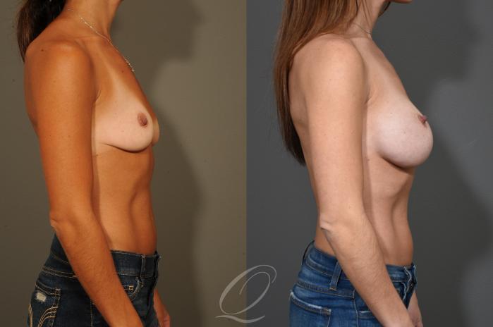 Breast Augmentation Case 325 Before & After View #3 | Serving Rochester, Syracuse & Buffalo, NY | Quatela Center for Plastic Surgery