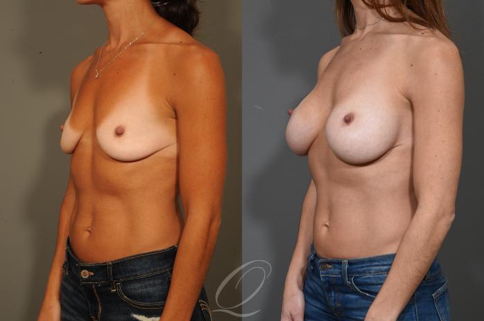 Breast Augmentation Case 325 Before & After View #4 | Serving Rochester, Syracuse & Buffalo, NY | Quatela Center for Plastic Surgery