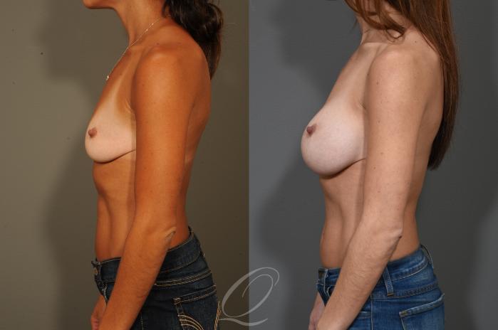 Breast Augmentation Case 325 Before & After View #5 | Serving Rochester, Syracuse & Buffalo, NY | Quatela Center for Plastic Surgery