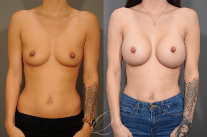 Breast Augmentation Case 332 Before & After View #1 | Serving Rochester, Syracuse & Buffalo, NY | Quatela Center for Plastic Surgery