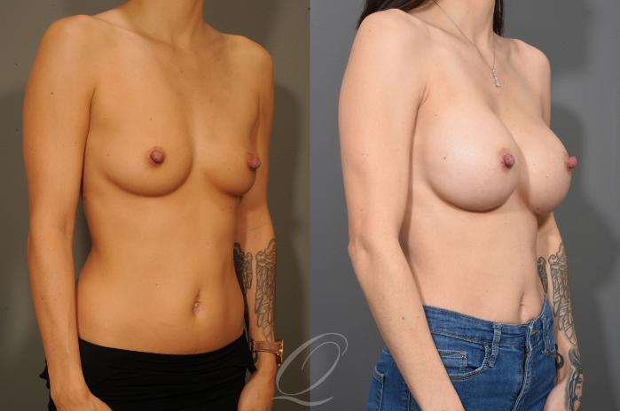 Breast Augmentation Case 332 Before & After View #2 | Serving Rochester, Syracuse & Buffalo, NY | Quatela Center for Plastic Surgery