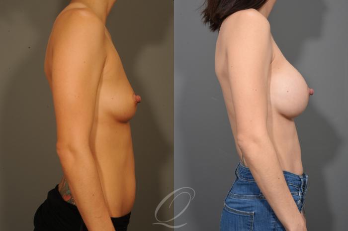 Breast Augmentation Case 332 Before & After View #3 | Serving Rochester, Syracuse & Buffalo, NY | Quatela Center for Plastic Surgery