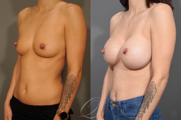 Breast Augmentation Case 332 Before & After View #4 | Serving Rochester, Syracuse & Buffalo, NY | Quatela Center for Plastic Surgery