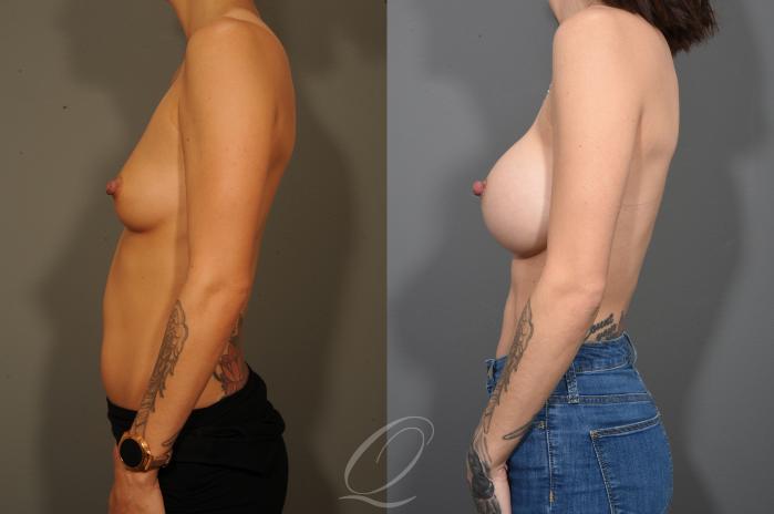 Breast Augmentation Case 332 Before & After View #5 | Serving Rochester, Syracuse & Buffalo, NY | Quatela Center for Plastic Surgery