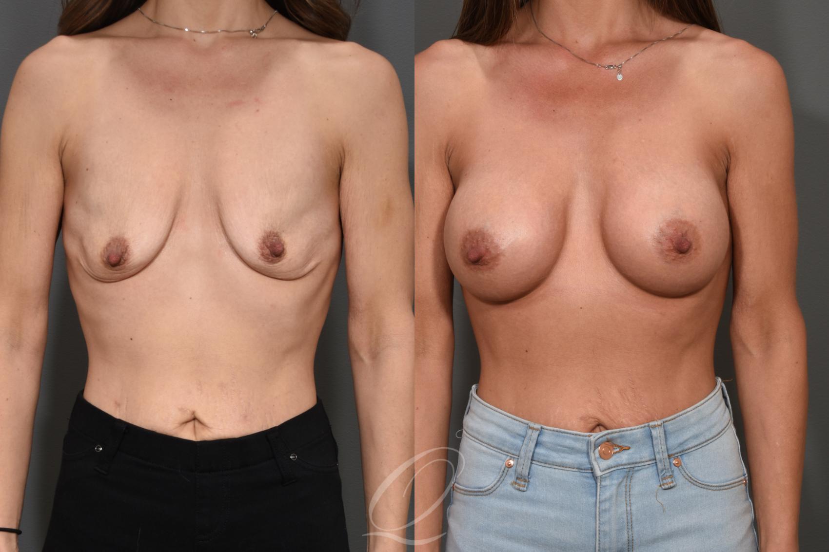 Breast Augmentation Case 345 Before & After View #1 | Serving Rochester, Syracuse & Buffalo, NY | Quatela Center for Plastic Surgery
