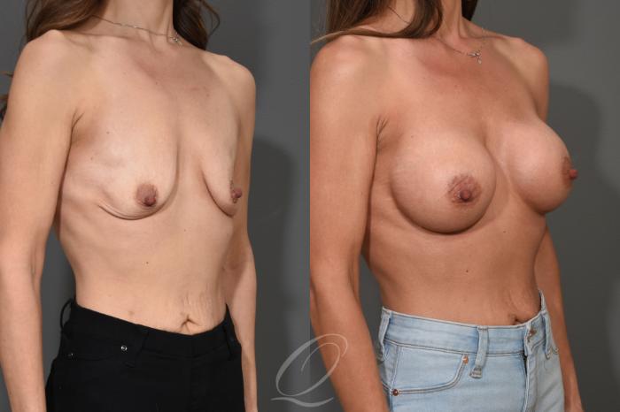 Breast Augmentation Case 345 Before & After View #2 | Serving Rochester, Syracuse & Buffalo, NY | Quatela Center for Plastic Surgery