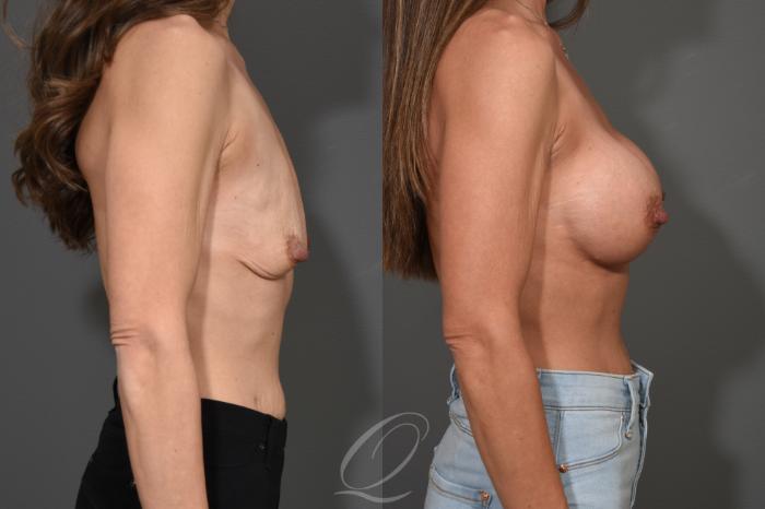 Breast Augmentation Case 345 Before & After View #3 | Serving Rochester, Syracuse & Buffalo, NY | Quatela Center for Plastic Surgery
