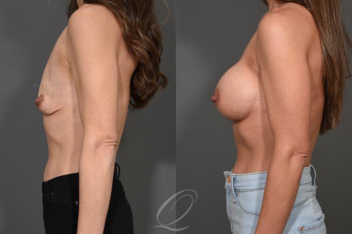 Breast Augmentation Case 345 Before & After View #5 | Serving Rochester, Syracuse & Buffalo, NY | Quatela Center for Plastic Surgery