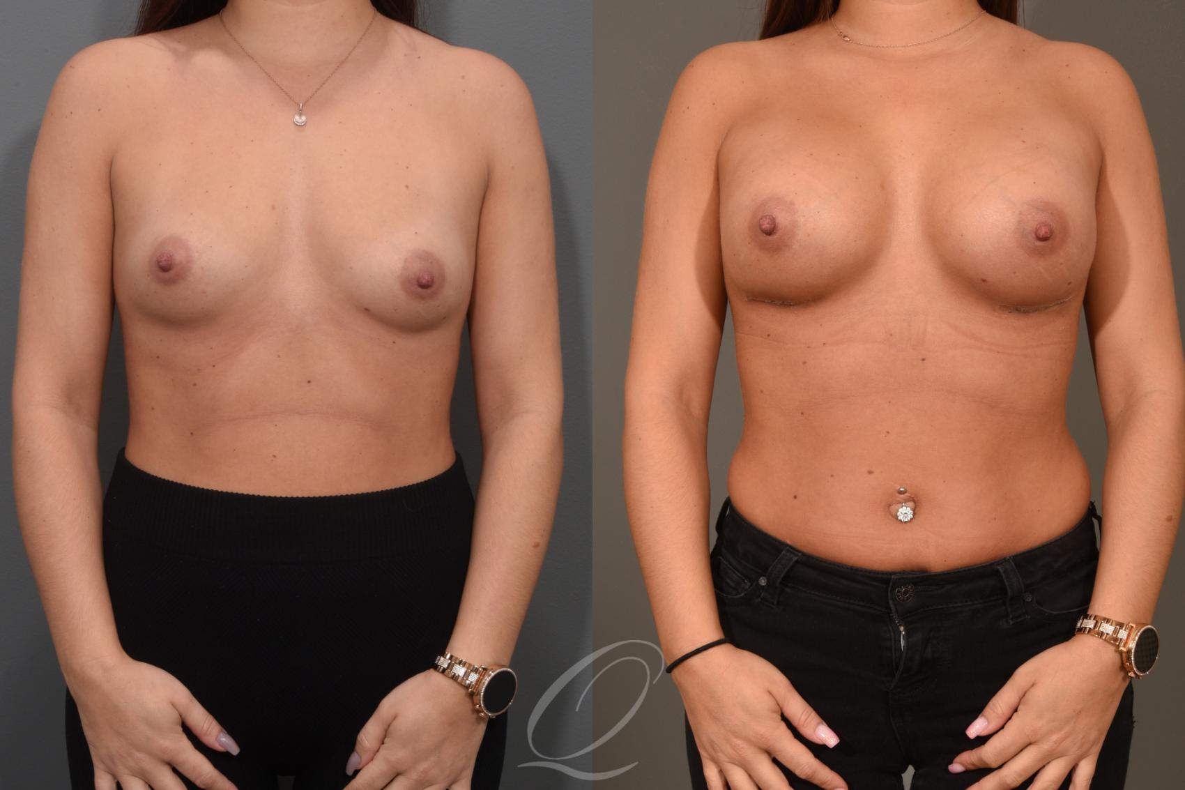 Breast Augmentation Case 374 Before & After View #1 | Serving Rochester, Syracuse & Buffalo, NY | Quatela Center for Plastic Surgery