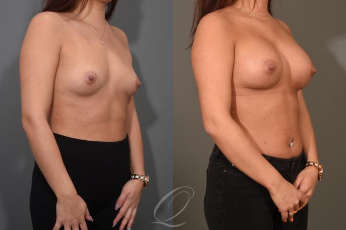 Breast Augmentation Case 374 Before & After View #2 | Serving Rochester, Syracuse & Buffalo, NY | Quatela Center for Plastic Surgery