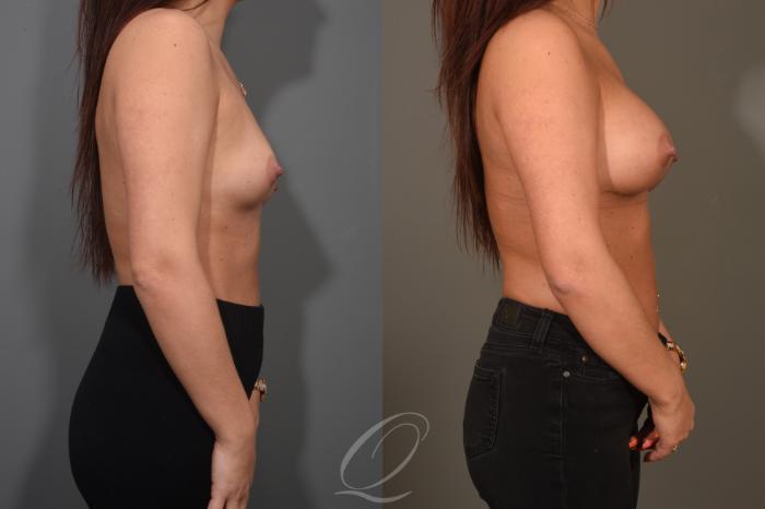 Breast Augmentation Case 374 Before & After View #3 | Serving Rochester, Syracuse & Buffalo, NY | Quatela Center for Plastic Surgery