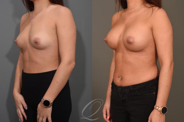 Breast Augmentation Case 374 Before & After View #4 | Serving Rochester, Syracuse & Buffalo, NY | Quatela Center for Plastic Surgery