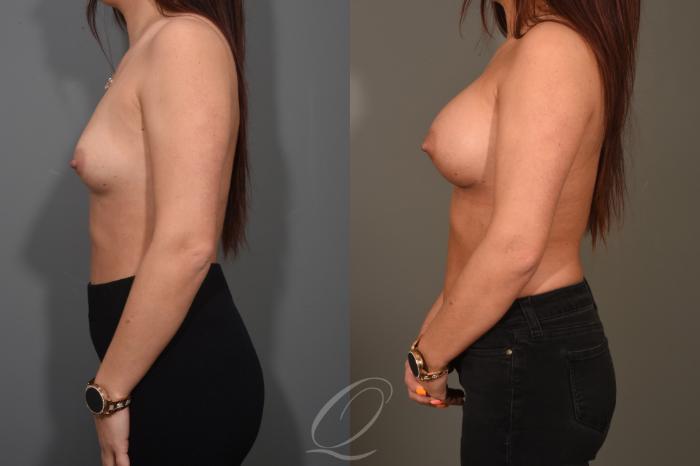Breast Augmentation Case 374 Before & After View #5 | Serving Rochester, Syracuse & Buffalo, NY | Quatela Center for Plastic Surgery