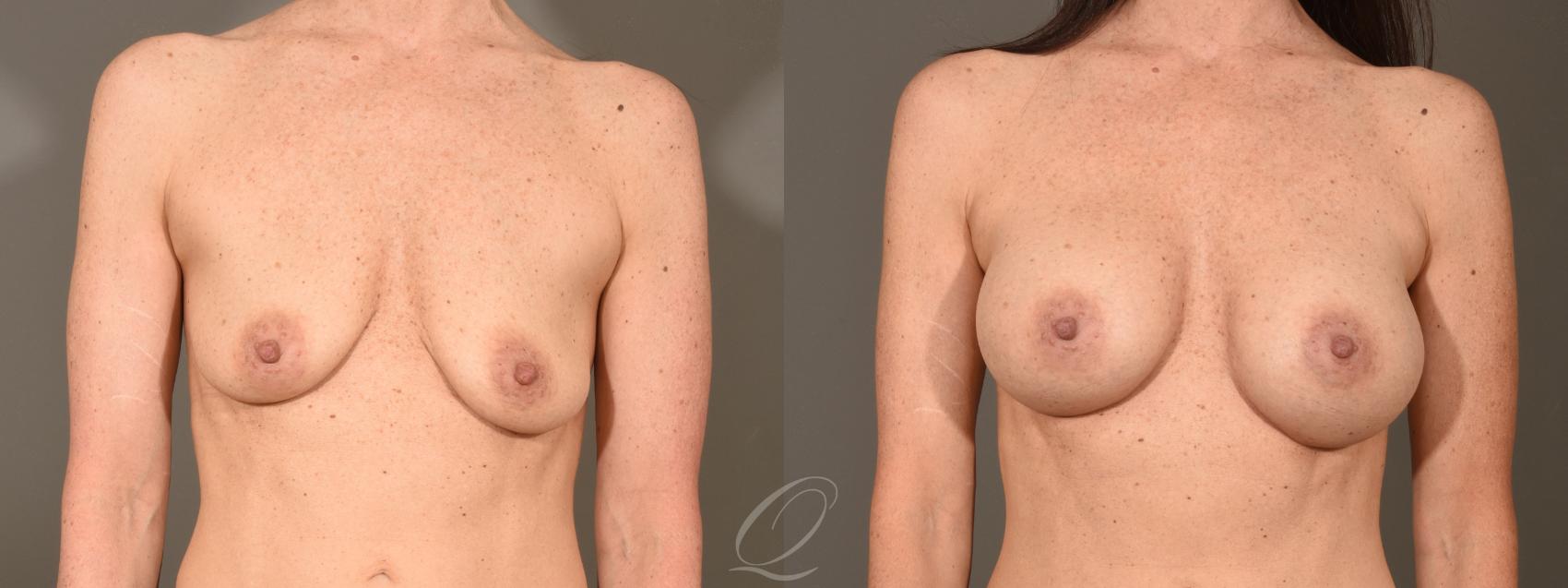 Breast Augmentation Case 379 Before & After View #1 | Serving Rochester, Syracuse & Buffalo, NY | Quatela Center for Plastic Surgery