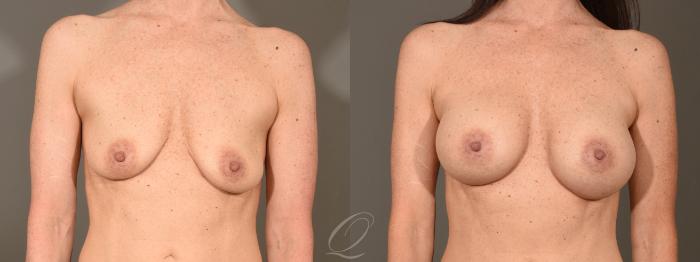 Breast Augmentation Case 379 Before & After View #1 | Serving Rochester, Syracuse & Buffalo, NY | Quatela Center for Plastic Surgery