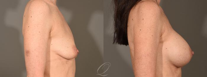 Breast Augmentation Case 379 Before & After View #3 | Serving Rochester, Syracuse & Buffalo, NY | Quatela Center for Plastic Surgery