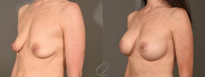 Breast Augmentation Case 379 Before & After View #4 | Serving Rochester, Syracuse & Buffalo, NY | Quatela Center for Plastic Surgery