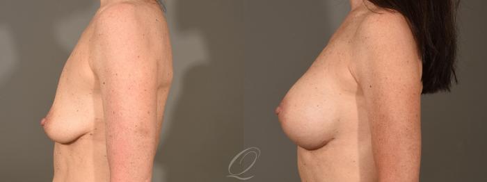 Breast Augmentation Case 379 Before & After View #5 | Serving Rochester, Syracuse & Buffalo, NY | Quatela Center for Plastic Surgery