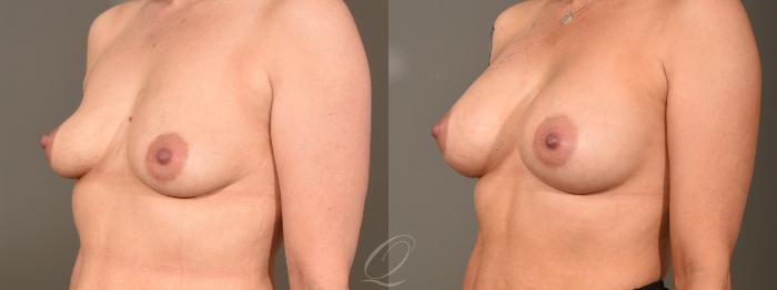 Breast Augmentation Case 380 Before & After View #2 | Serving Rochester, Syracuse & Buffalo, NY | Quatela Center for Plastic Surgery