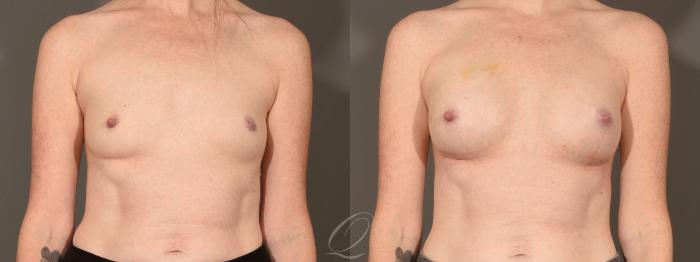 Breast Augmentation Case 392 Before & After Front | Serving Rochester, Syracuse & Buffalo, NY | Quatela Center for Plastic Surgery