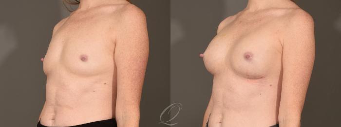 Breast Augmentation Case 392 Before & After Left Oblique | Serving Rochester, Syracuse & Buffalo, NY | Quatela Center for Plastic Surgery