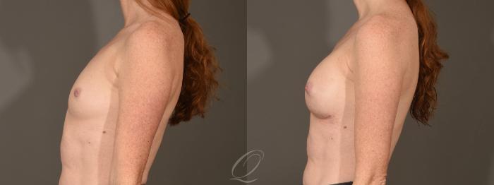 Breast Augmentation Case 392 Before & After Left Side | Serving Rochester, Syracuse & Buffalo, NY | Quatela Center for Plastic Surgery