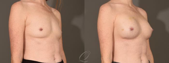 Breast Augmentation Case 392 Before & After Right Oblique | Serving Rochester, Syracuse & Buffalo, NY | Quatela Center for Plastic Surgery