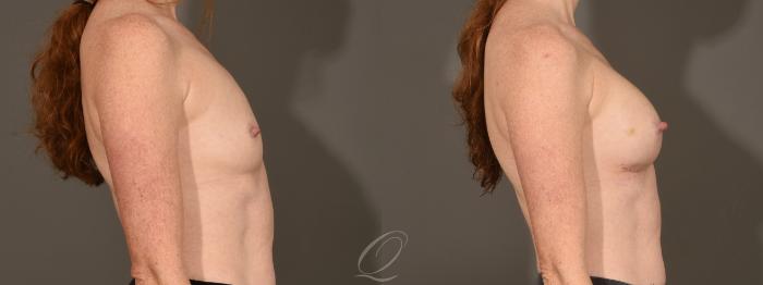 Breast Augmentation Case 392 Before & After Right Side | Serving Rochester, Syracuse & Buffalo, NY | Quatela Center for Plastic Surgery