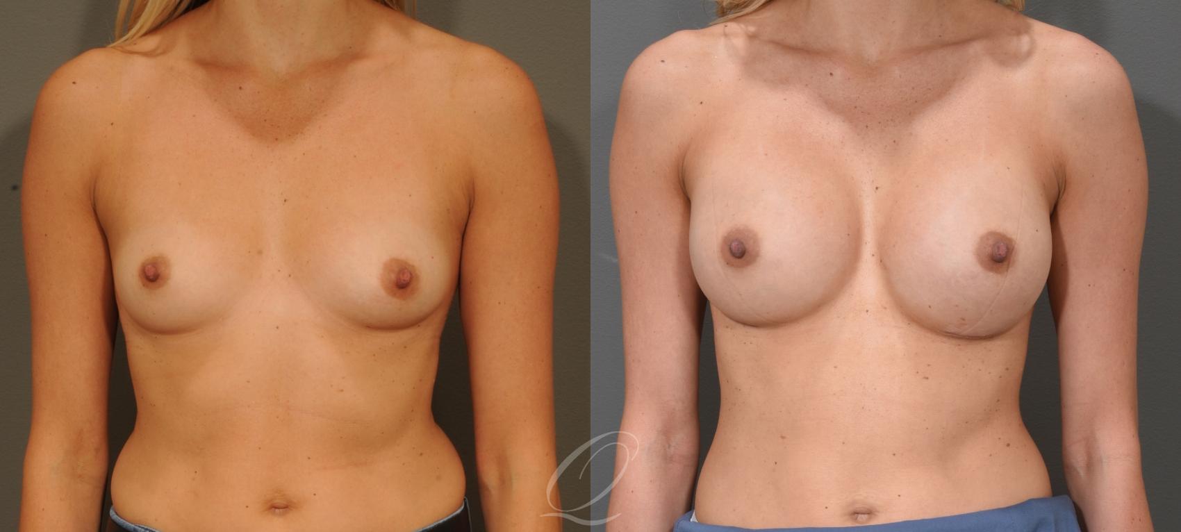 Breast Augmentation Case 399 Before & After Front | Serving Rochester, Syracuse & Buffalo, NY | Quatela Center for Plastic Surgery