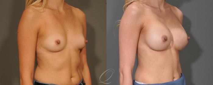 Breast Augmentation Case 399 Before & After Right Oblique | Serving Rochester, Syracuse & Buffalo, NY | Quatela Center for Plastic Surgery