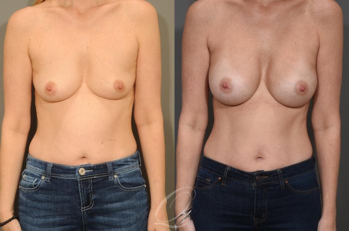 Breast Augmentation Case 400 Before & After Front | Serving Rochester, Syracuse & Buffalo, NY | Quatela Center for Plastic Surgery