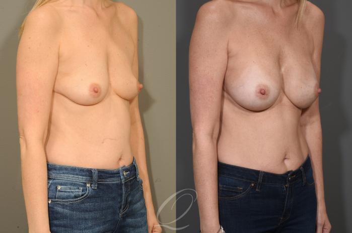 Breast Augmentation Case 400 Before & After Right Oblique | Serving Rochester, Syracuse & Buffalo, NY | Quatela Center for Plastic Surgery