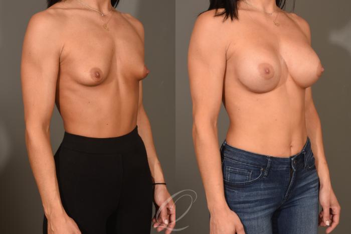 Breast Augmentation Case 401 Before & After Right Oblique | Serving Rochester, Syracuse & Buffalo, NY | Quatela Center for Plastic Surgery
