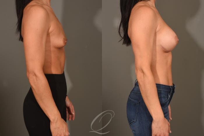 Breast Augmentation Case 401 Before & After Right Side | Serving Rochester, Syracuse & Buffalo, NY | Quatela Center for Plastic Surgery