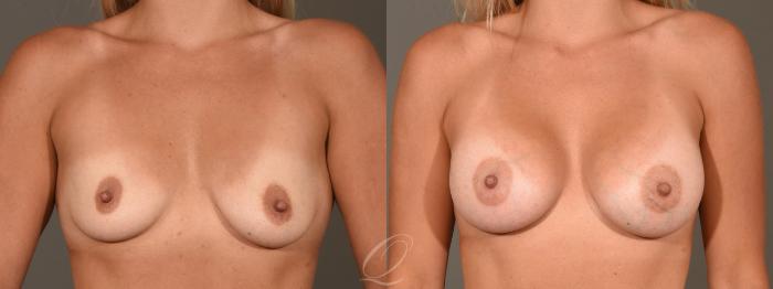 Breast Augmentation Case 402 Before & After Front | Serving Rochester, Syracuse & Buffalo, NY | Quatela Center for Plastic Surgery