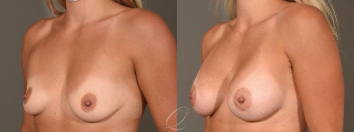 Breast Augmentation Case 402 Before & After Left Oblique | Serving Rochester, Syracuse & Buffalo, NY | Quatela Center for Plastic Surgery