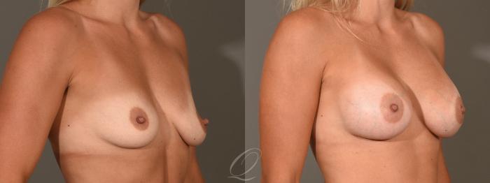 Breast Augmentation Case 402 Before & After Right Oblique | Serving Rochester, Syracuse & Buffalo, NY | Quatela Center for Plastic Surgery