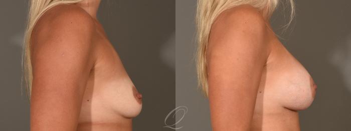 Breast Augmentation Case 402 Before & After Right Side | Serving Rochester, Syracuse & Buffalo, NY | Quatela Center for Plastic Surgery
