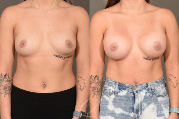 Breast Augmentation Case 403 Before & After Front | Serving Rochester, Syracuse & Buffalo, NY | Quatela Center for Plastic Surgery
