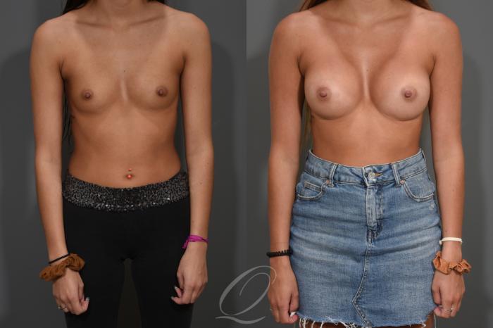 Breast Augmentation Case 410 Before & After Front | Serving Rochester, Syracuse & Buffalo, NY | Quatela Center for Plastic Surgery