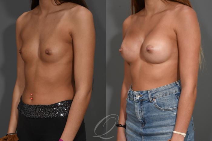 Breast Augmentation Case 410 Before & After Left Oblique | Serving Rochester, Syracuse & Buffalo, NY | Quatela Center for Plastic Surgery