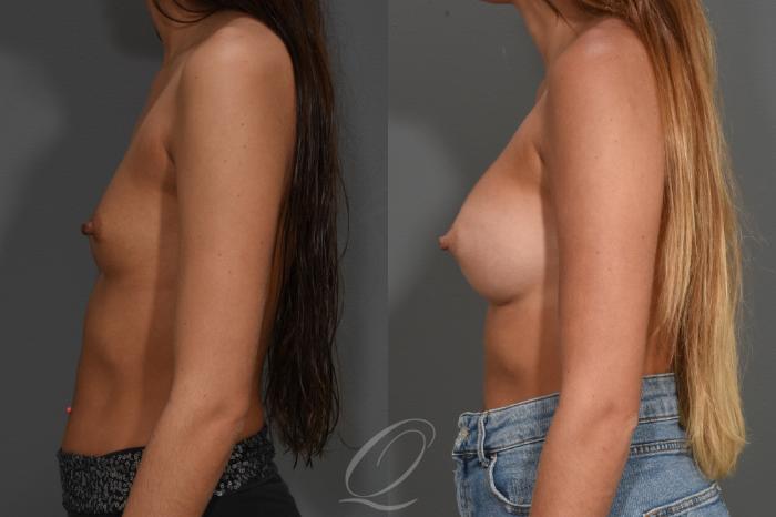 Breast Augmentation Case 410 Before & After Left Side | Serving Rochester, Syracuse & Buffalo, NY | Quatela Center for Plastic Surgery