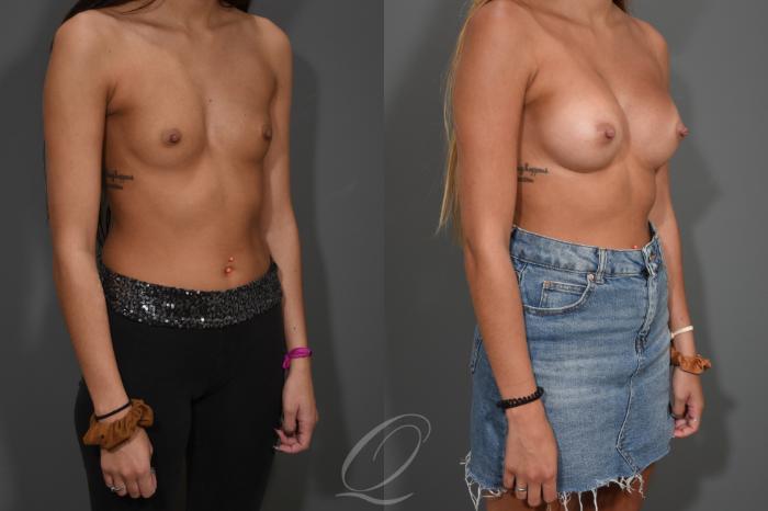 Breast Augmentation Case 410 Before & After Right Oblique | Serving Rochester, Syracuse & Buffalo, NY | Quatela Center for Plastic Surgery