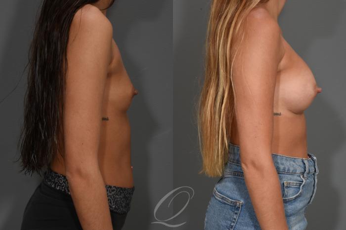 Breast Augmentation Case 410 Before & After Right Side | Serving Rochester, Syracuse & Buffalo, NY | Quatela Center for Plastic Surgery
