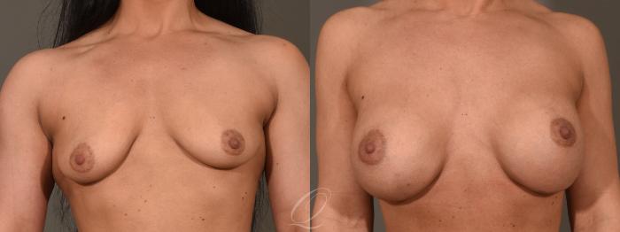 Breast Augmentation Case 416 Before & After Front | Serving Rochester, Syracuse & Buffalo, NY | Quatela Center for Plastic Surgery