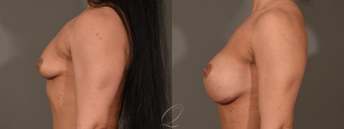 Breast Augmentation Case 416 Before & After Left Side | Serving Rochester, Syracuse & Buffalo, NY | Quatela Center for Plastic Surgery