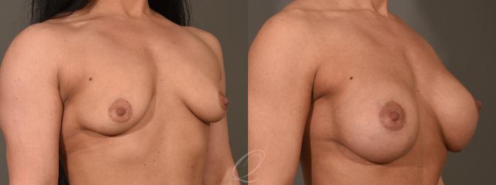 Breast Augmentation Case 416 Before & After Right Oblique | Serving Rochester, Syracuse & Buffalo, NY | Quatela Center for Plastic Surgery