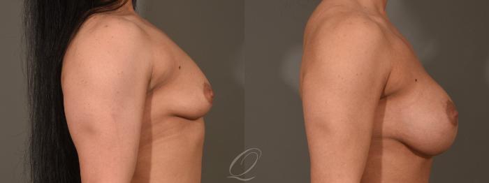 Breast Augmentation Case 416 Before & After Right Side | Serving Rochester, Syracuse & Buffalo, NY | Quatela Center for Plastic Surgery