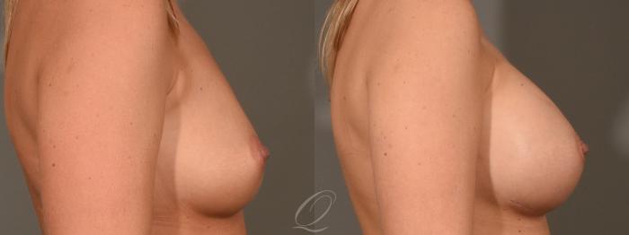 Breast Augmentation Case 417 Before & After Right Side | Serving Rochester, Syracuse & Buffalo, NY | Quatela Center for Plastic Surgery